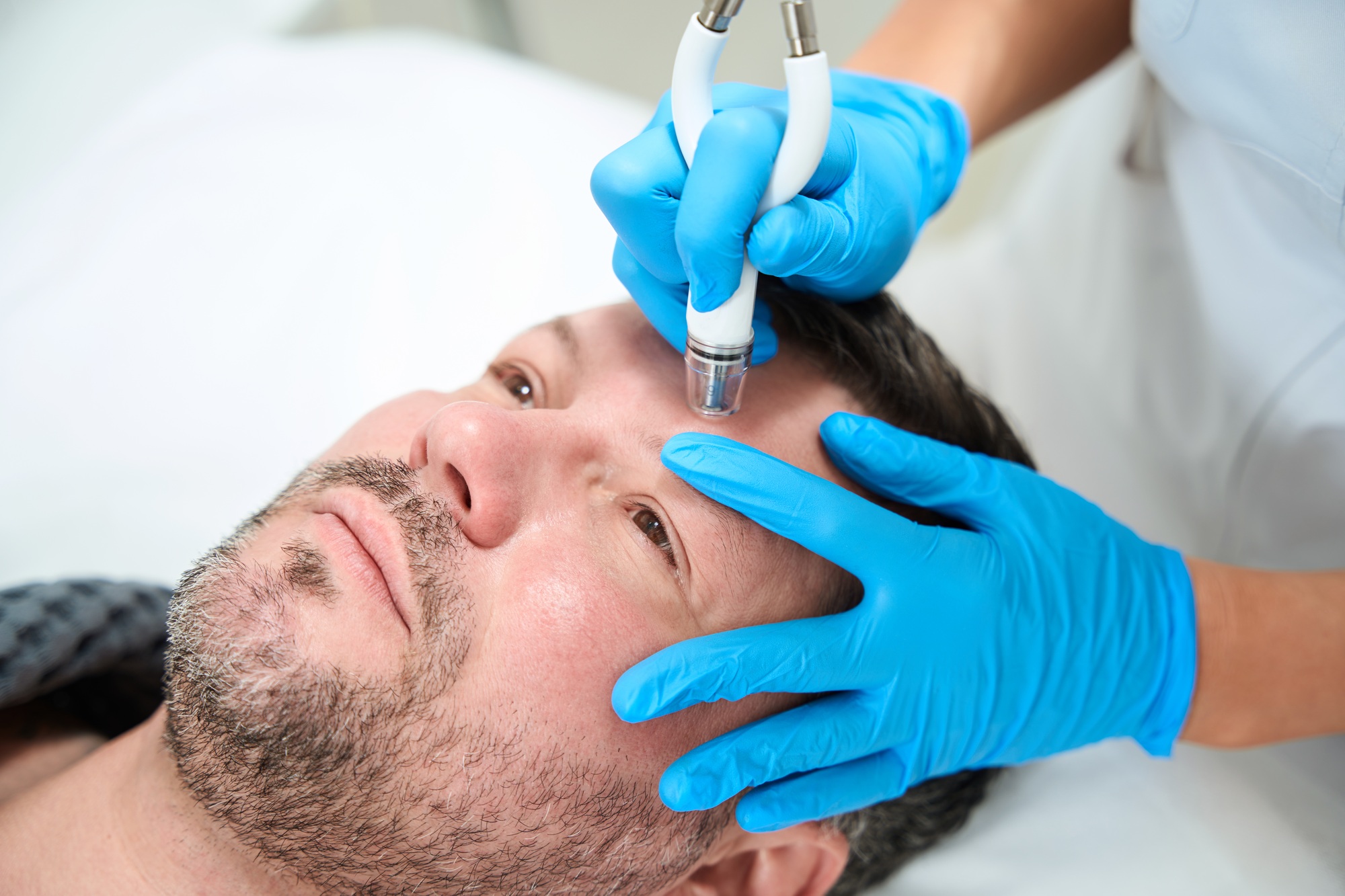 Beautician processes the forehead of a man with CO2 laser
